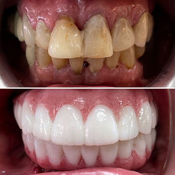 dentures