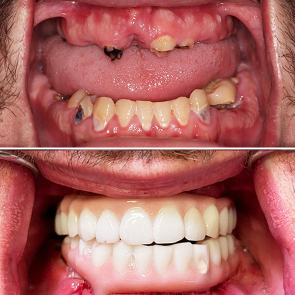 Broken front tooth restored with a single porcelain crown