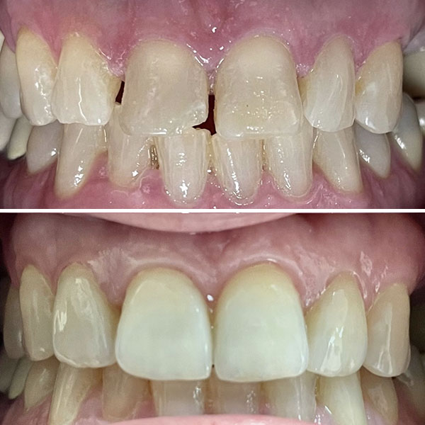 Broken front tooth restored with a single porcelain crown
