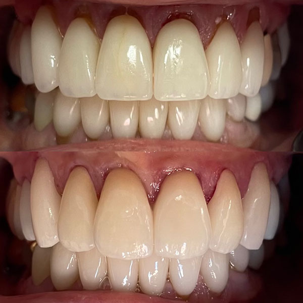 Broken front tooth restored with a single porcelain crown