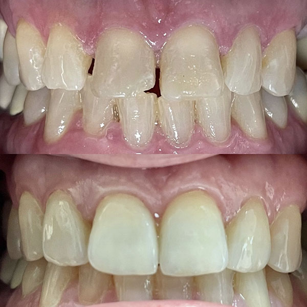 Broken front tooth restored with a single porcelain crown