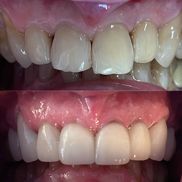 Broken front tooth restored with a single porcelain crown