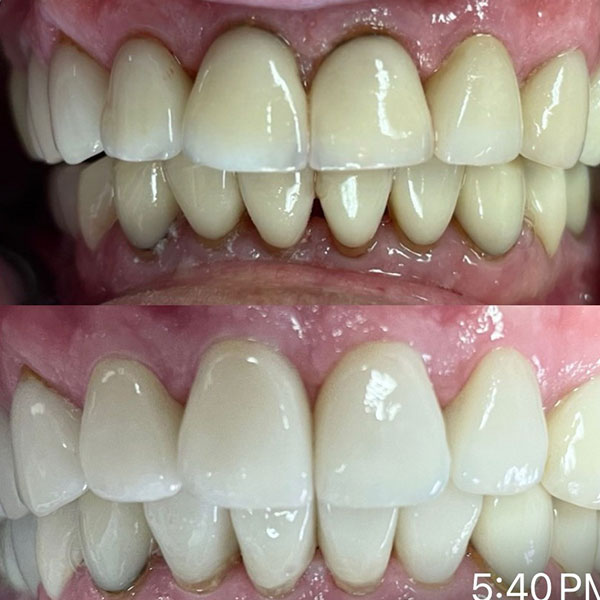 Broken front tooth restored with a single porcelain crown