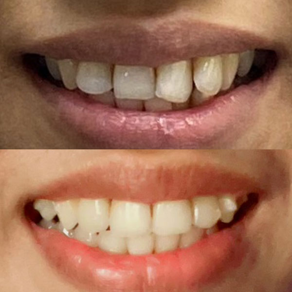 Broken front tooth restored with a single porcelain crown